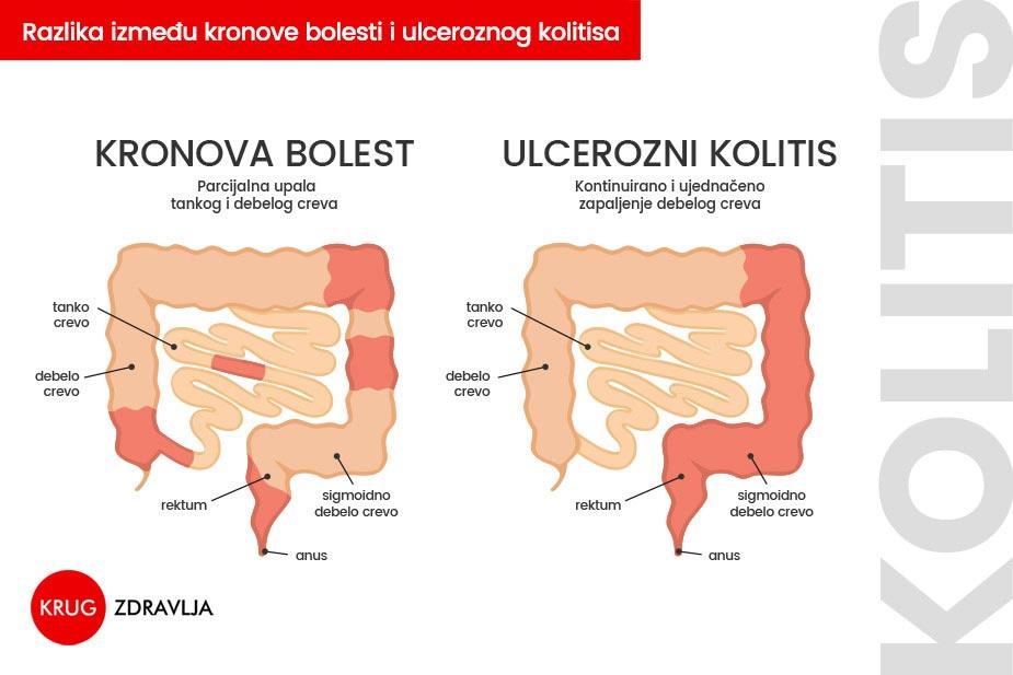 Ulcerozni kolitis i Kronova bolest razlike