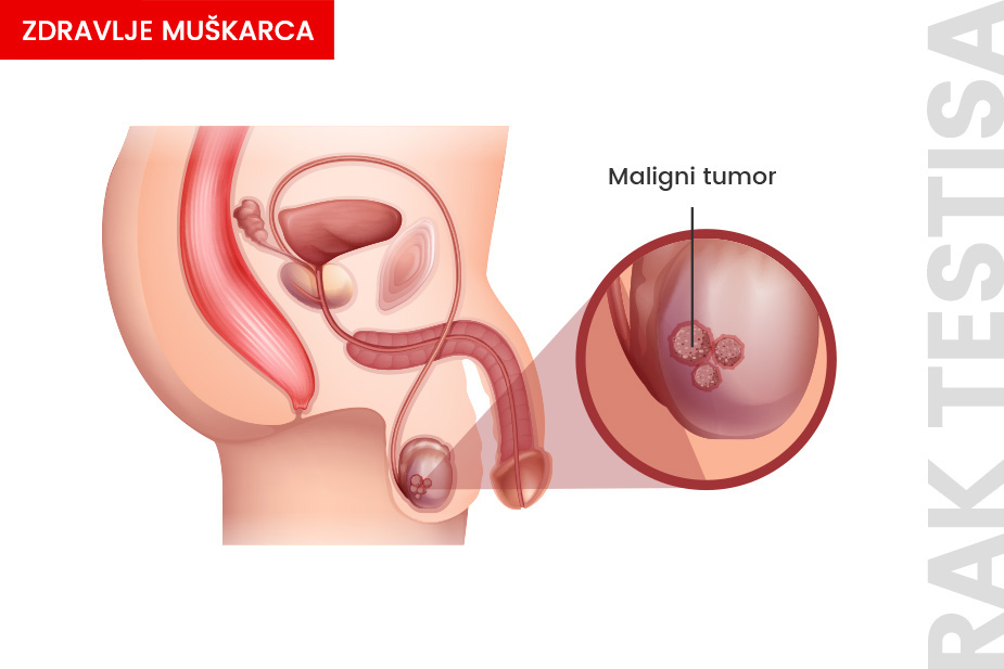 Ilustracija tumora na testisu