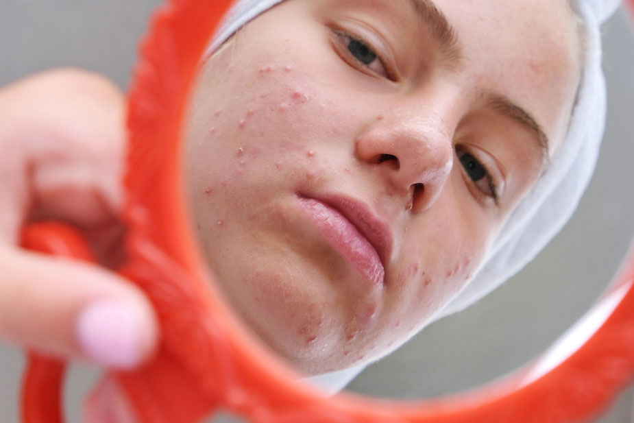 Blizak prikaz lica s aknama dok žena traži rešenje za problematičnu kožu u ogledalu.